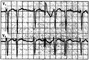 心电图如下图所示,提示为a,心房颤动b,心房扑动伴室内差异性传导c,心