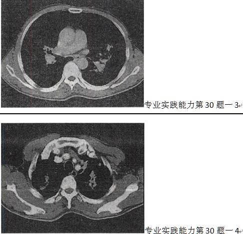 肺气肿桶状胸图片